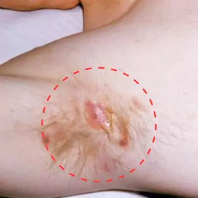 hidradenitis suppurativa stage 3 pictures