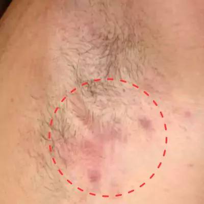 hidradenitis suppurativa pictures