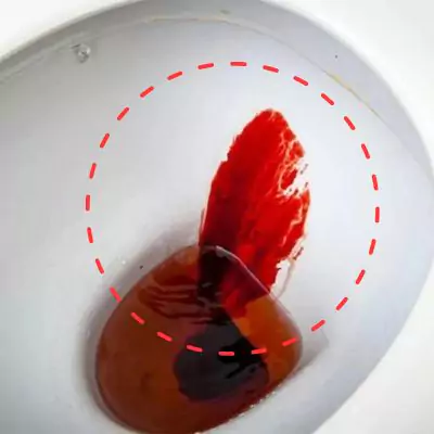 what does it mean when you poop blood