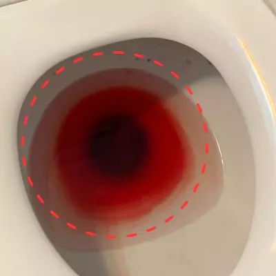 large amount of bright red blood in toilet no pain