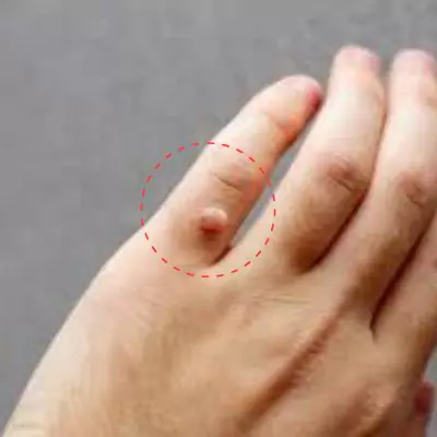 Remedies to remove red warts