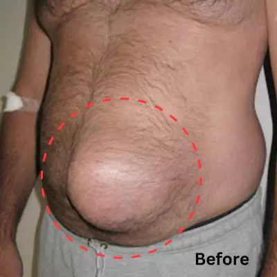 stomach before and after hernia surgery