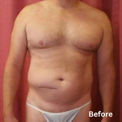 umbilical hernia before and after