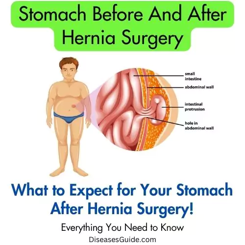 Stomach Before And After Hernia Surgery