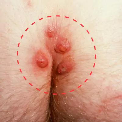 hard painful lump on buttocks