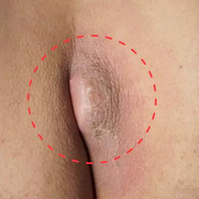 woman pilonidal cyst pictures