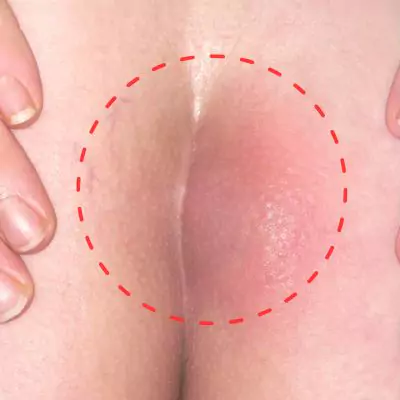 swollen lump on buttock how to treat