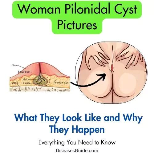 woman pilonidal cyst pictures