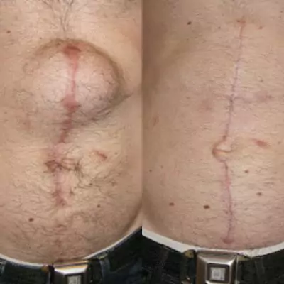 before and after inguinal hernia surgery pictures