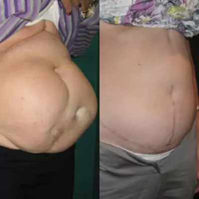 abdominal wall reconstruction before and after