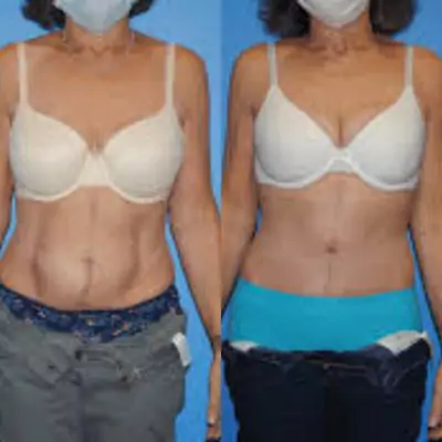 before and after diastasis abdominal