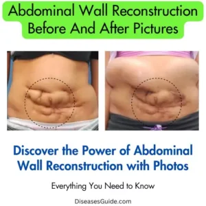 Abdominal Wall Reconstruction Before And After Picture