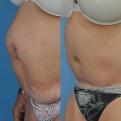 diastasis recti surgery laparoscopic before and after