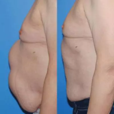 diastasis recti surgery before and after photos