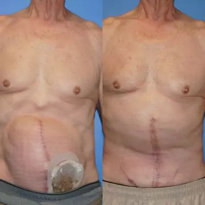 ventral hernia repair before and after pictures