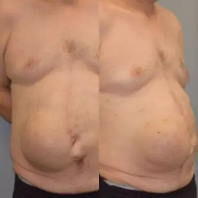 abdominal wall reconstruction before and after pictures