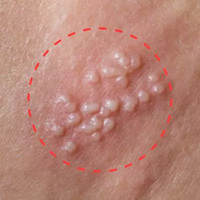 Chlamydia Rash On Inner Thigh Female