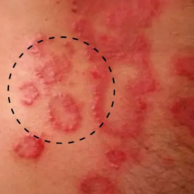 Chlamydia Rash On Inner Thigh Female