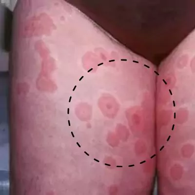 Chlamydia Rash On Inner Thigh Female