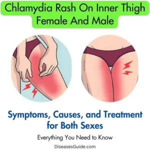 Chlamydia Rash On Inner Thigh Female And Male