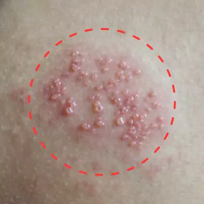 Chlamydia Rash On Inner Thigh Female