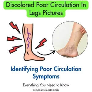 Discolored Poor Circulation In Legs Pictures