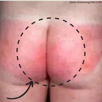 yeast infection on buttocks pictures