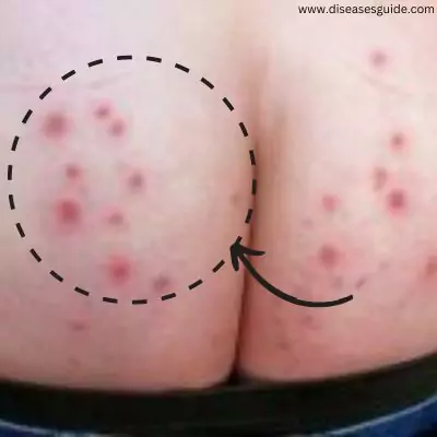 yeast infection under breast pictures