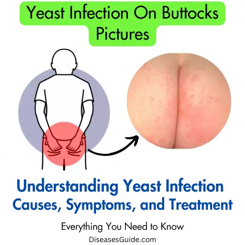 Yeast Infection On Buttocks Pictures